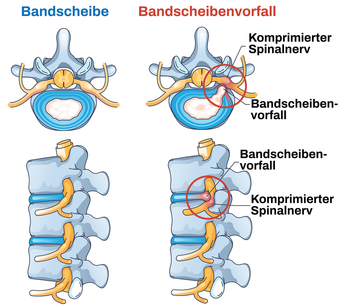 Finural Bei Bandscheibenvorfall: Welche Symptome Bei ...