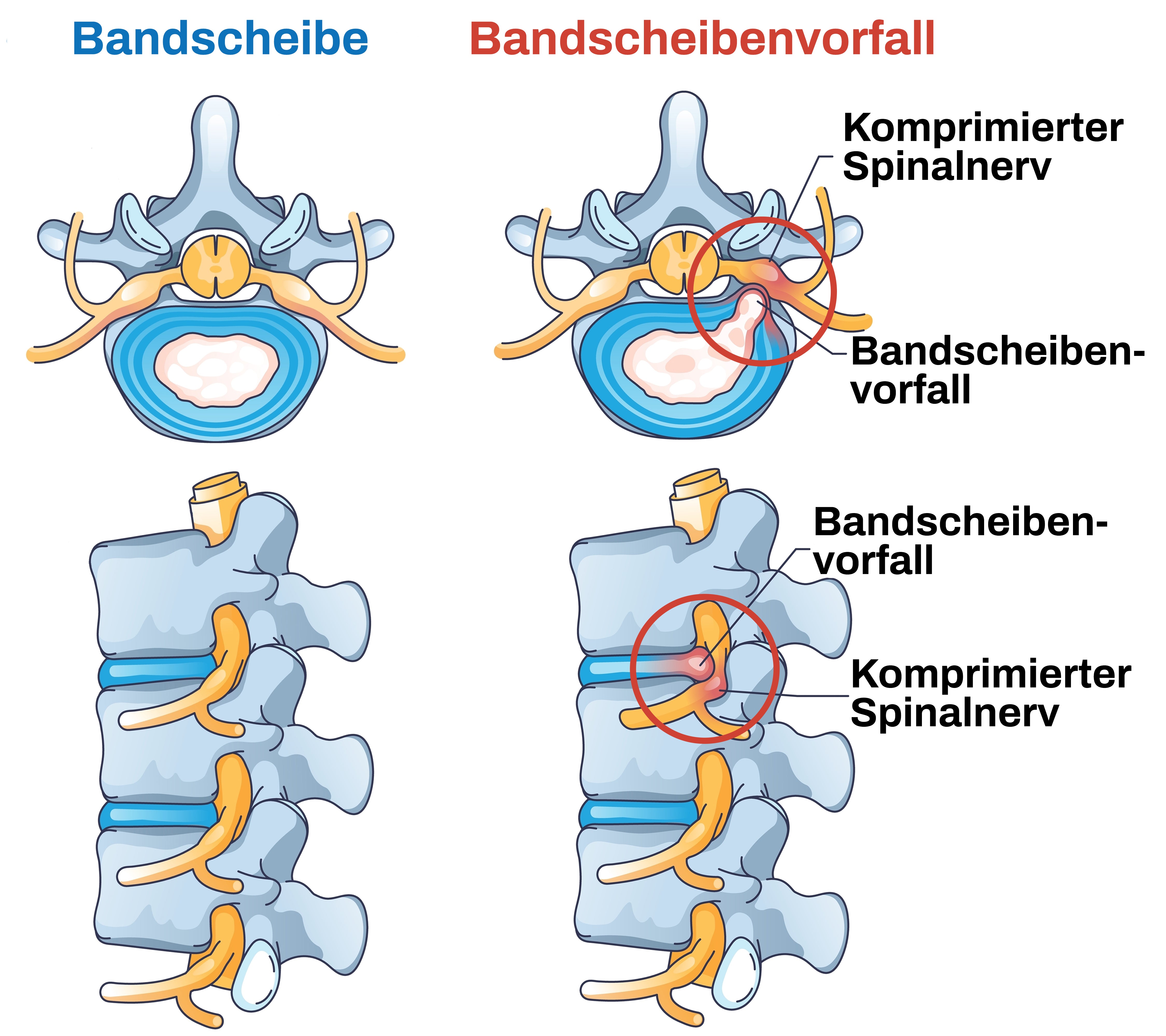 Wie Du bei einem Bandscheibenvorfall die Heilung beschleunigen kannst